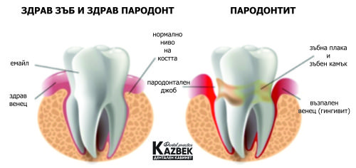 здрав зъб пародонтит